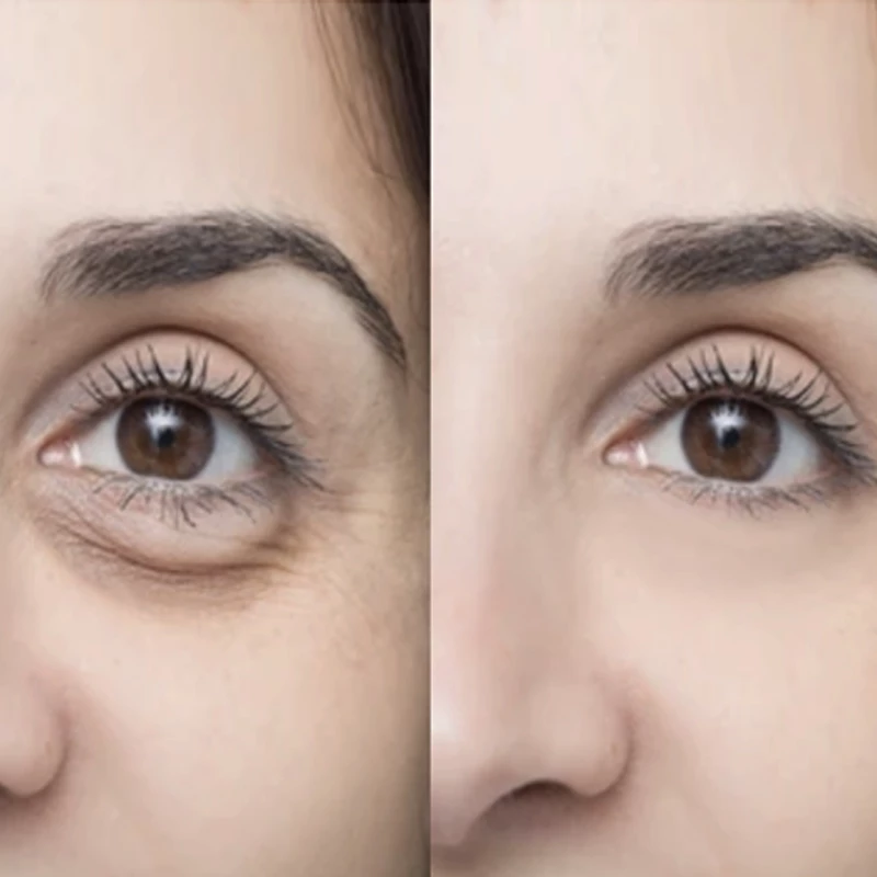 Blefaroplastia